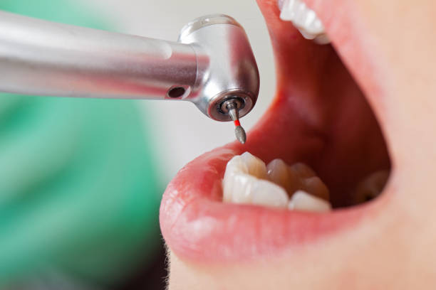 Best Emergency Tooth Extraction  in Fox Farm College, WY